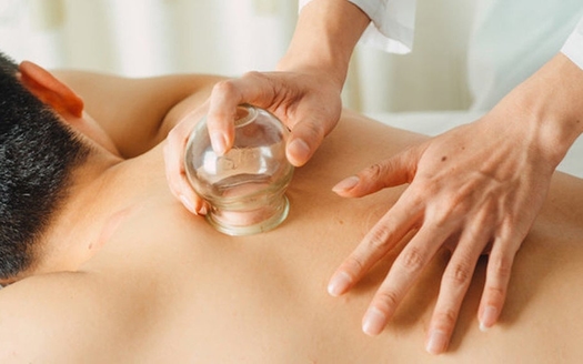Akupunktur med eller uden cupping